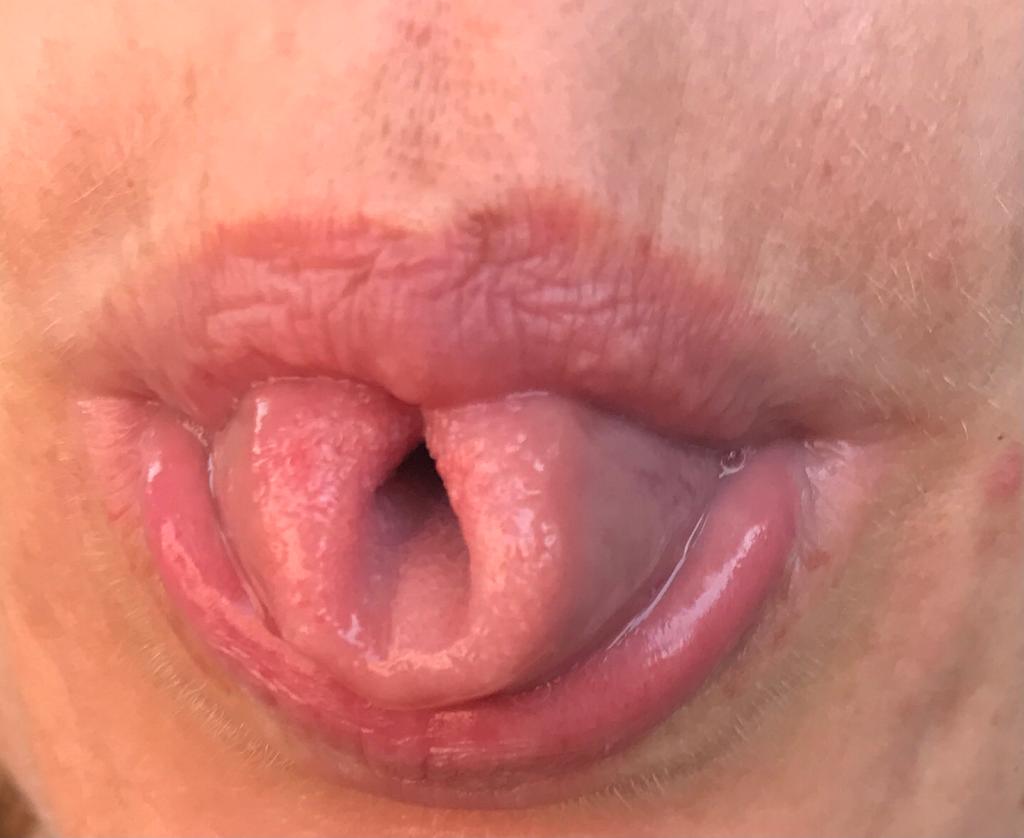 Boca con lengua doblada